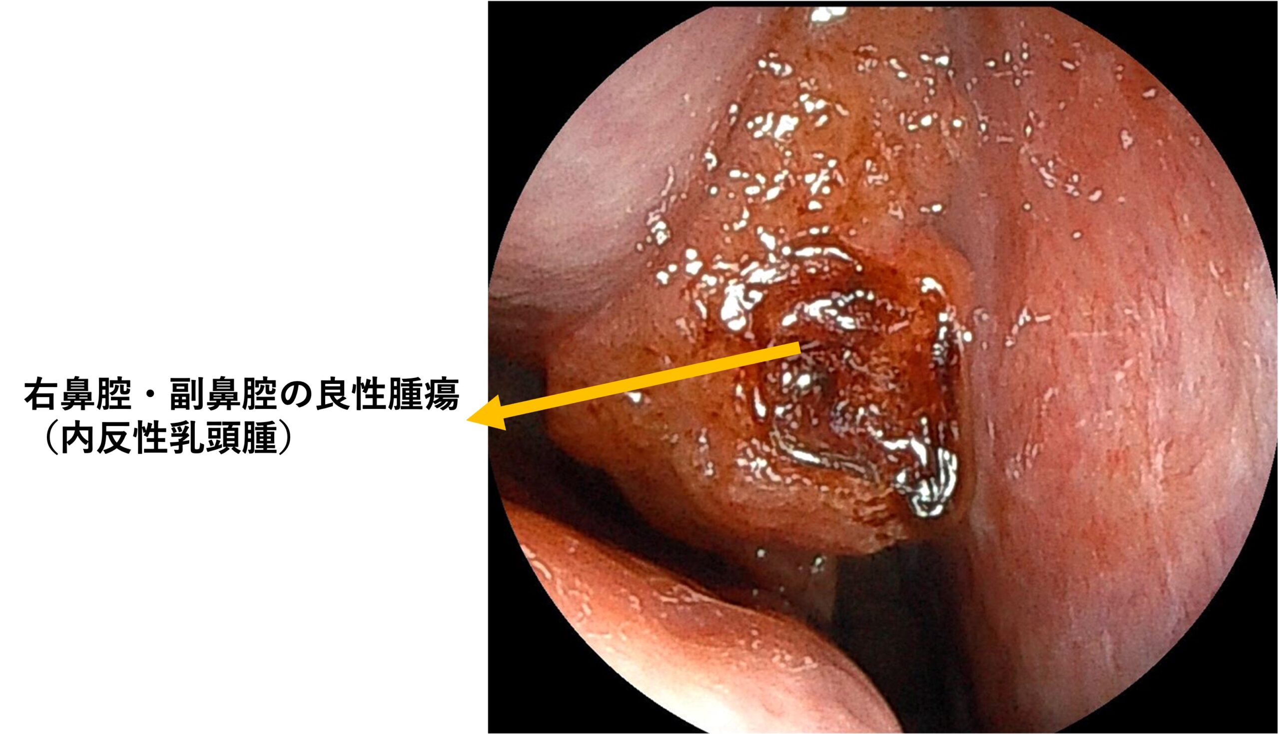 鼻腔・副鼻腔腫瘍のイメージ